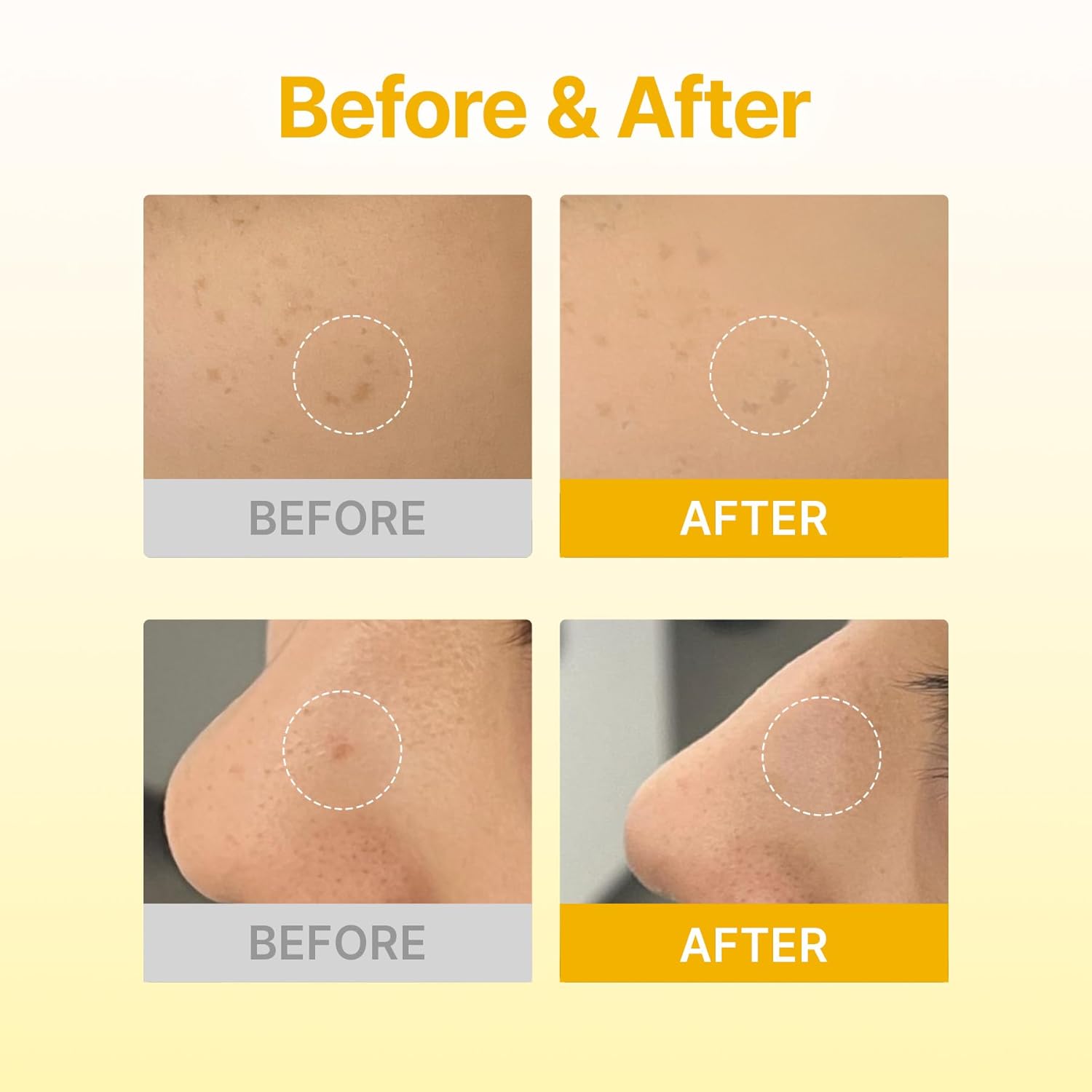 Dark Spot Care Microcone Patch