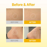 Dark Spot Care Microcone Patch